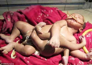 الهند: ولادة طفل بأربعة أرجل وأربعة أذرع يثير الرعب.