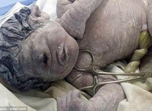بعد تعرض والدته للإشعاع أثناء الحمل.. طفل بعين واحدة في مصر!