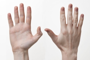 هل هناك علاقة بين طول أصابع يدك وإصابتك بالشيزوفرينيا؟