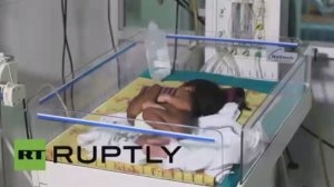  بالفيديو...حالة نادرة..ولادة توأم طفيلي من دون رأس وصدر في الهند