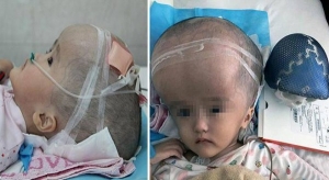طفلة صينية تصبح أول شخص في العالم بجمجمة اصطناعية 
