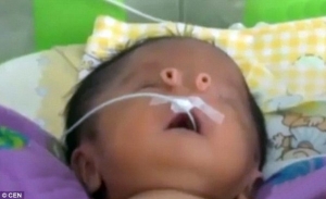 ولادة طفل بأنبوبين في وجهه بدلا من أنف  