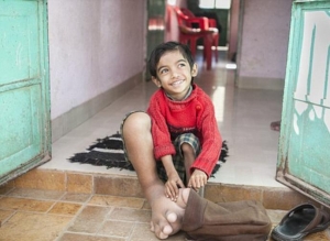 طفل هندي قدمه تزن 5 كيلو غرامات ويركض بشكل طبيعي