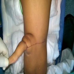 طفلة تولد بـ "ذيل" يتدلى من ظهرها بسبب حالة نادرة