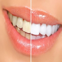 تبييض الاسنان وعلاج اللثة بمكون طبيعي واحد من اول استعمال