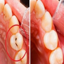 وصفة طبيعية للتخلص من تسوس الأسنان و إزالة الجير