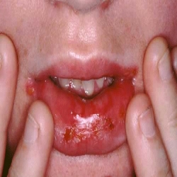 كيفية علاج فطريات الفم بالاعشاب