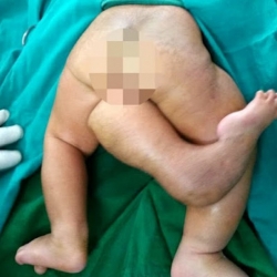 طفلة تولد بثلاث سيقان في الهند