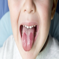 علاج فطريات اللسان عند الأطفال و الكبار بالوصفات الطبيعية