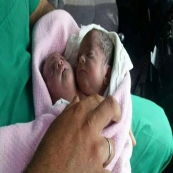  ولادة طفل برأسين في سوريا