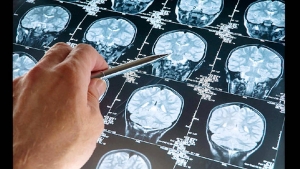 عقار جديد يثبت فعاليته في علاج أورام المخ