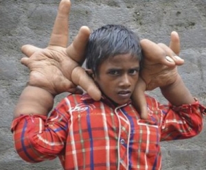 طفل هندي يبلغ وزن يديه 16 كيلوغراماً