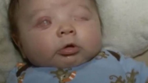 بالصور: طفل يولد بدون عينين في حالةٍ نادرة جداً 