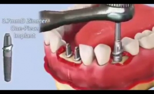 بالفيديو .. شاهد عملية زراعة الاسنان .. لاقوياء القلوب فقط ..