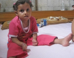 بالصور: طفلة من "غزة" أكلت سبعة من أصابع يديها بأسنانها دون أن تشعر بأي ألم!  