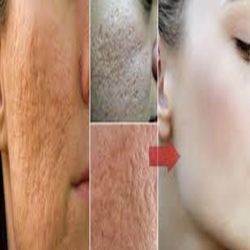  طريقة سهلة وطبيعية للقضاء على مسام الوجه المحرجة والحصول على بشرة أكثر نعومة