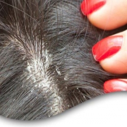 أسباب ظهور القشرة في الشعر