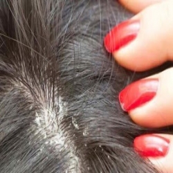 ما هى قشرة الشعر؟ لماذا تحدث؟ وكيف تعالجها نهائيًا بعيدًا عن الخرافات؟