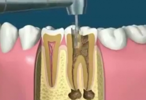شاهد بالفيديو كيق يعالج طبيب الاسنان اسنانكم !!