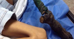 فتاة تعانى من تآكل ساقها وتعفنها نتيجة عضة ثعبان سام بفنزويلا